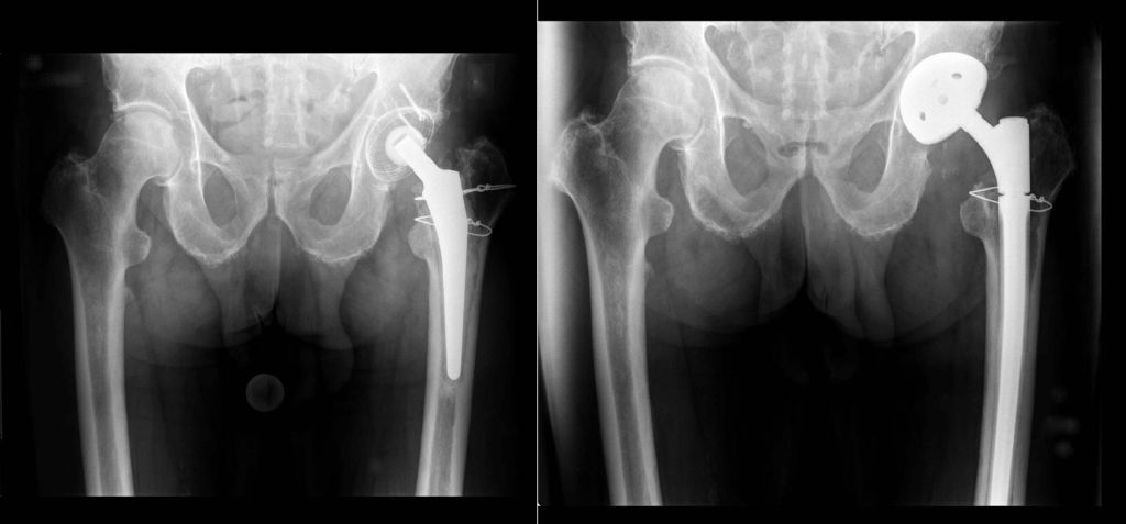 Röntgenbild eines Wechselimplantat einer Hüftprothese